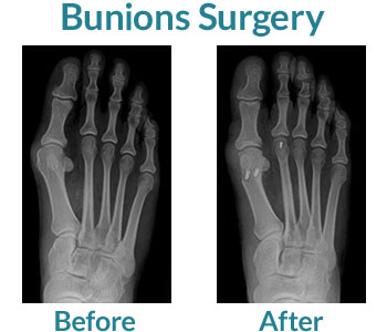 bunions